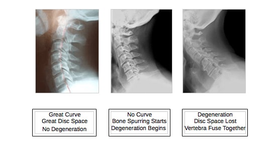 Chiropractic Oak Ridge TN Neck X-Ray